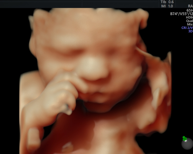 Ultrasonido de crecimiento y 3D