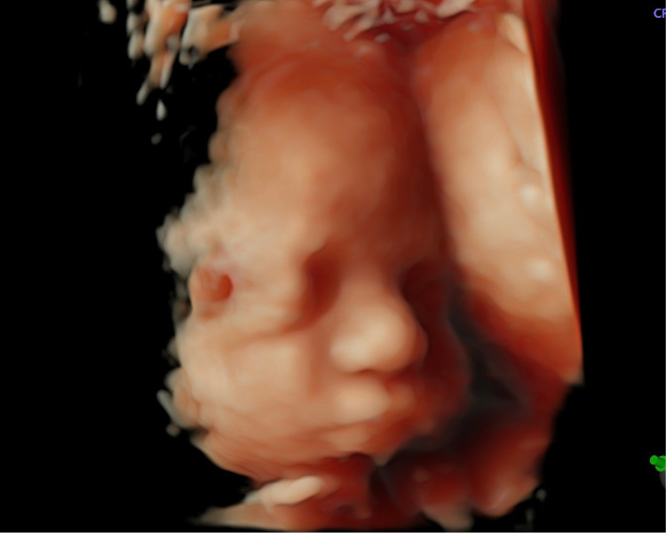 Ultrasonido estructural